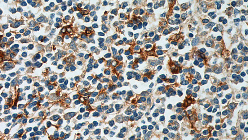 Immunohistochemistry of paraffin-embedded human tonsillitis tissue slide using Catalog No:110528(Fascin Antibody) at dilution of 1:200 (under 40x lens)