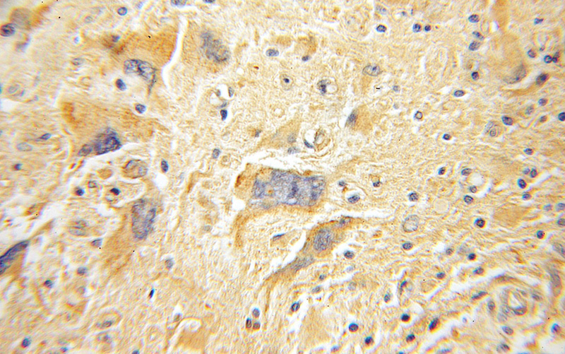 Immunohistochemical of paraffin-embedded human gliomas using Catalog No:110455(FAK antibody) at dilution of 1:100 (under 10x lens)