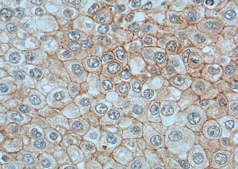 Immunohistochemistry of paraffin-embedded human breast cancer tissue slide using Catalog No:117346(Vinculin Antibody) at dilution of 1:200 (under 40x lens). heat mediated antigen retrieved with Tris-EDTA buffer(pH9).