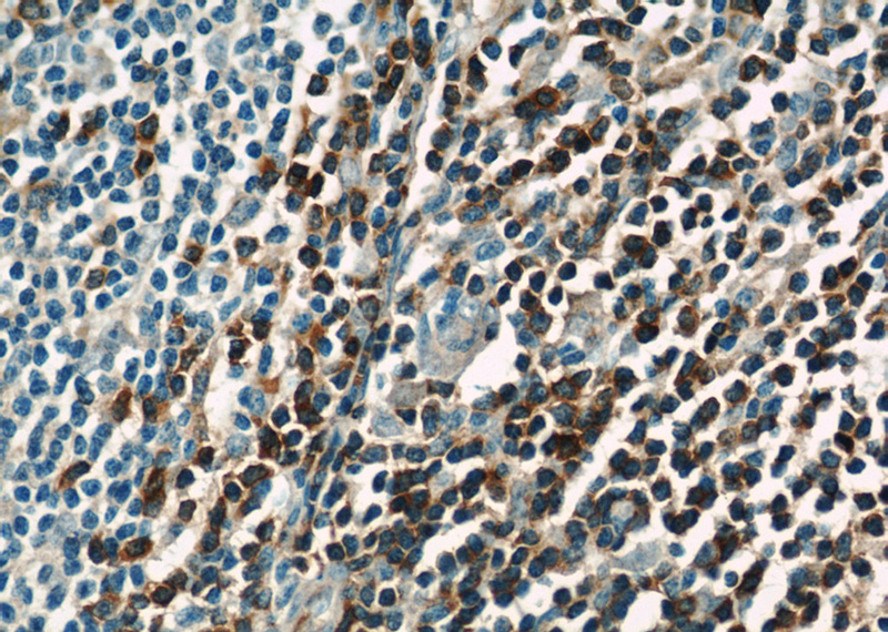 Immunohistochemical of paraffin-embedded human tonsillitis using Catalog No:115254(SKAP55,SKAP1 antibody) at dilution of 1:50 (under 40x lens)