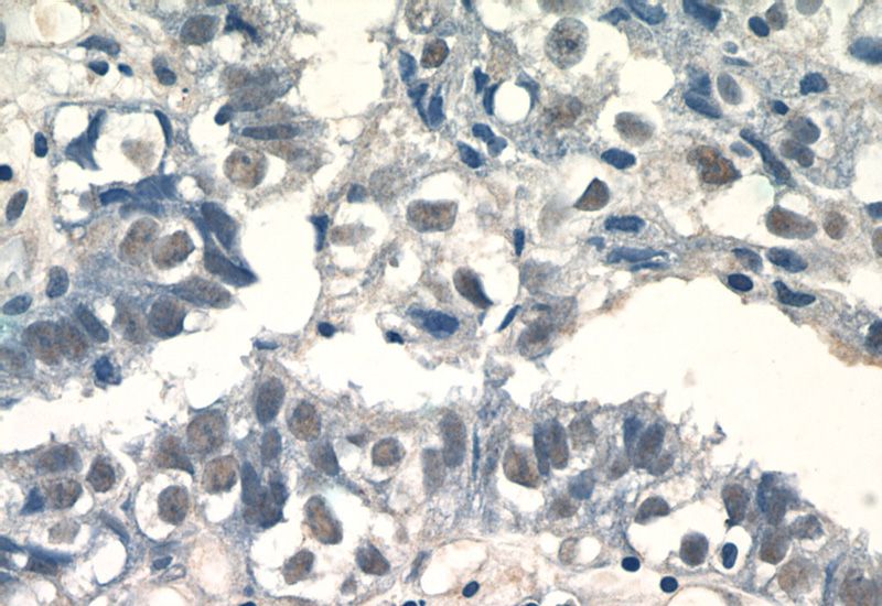Immunohistochemistry of paraffin-embedded human breast cancer tissue slide using Catalog No:116048(THoc5 Antibody) at dilution of 1:50 (under 40x lens)