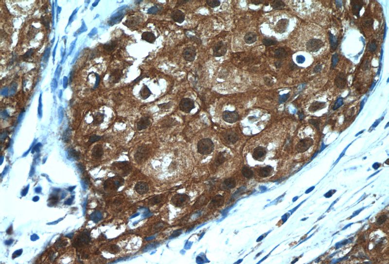 Immunohistochemistry of paraffin-embedded human breast cancer tissue slide using Catalog No:115592(SRP54 Antibody) at dilution of 1:50 (under 40x lens)