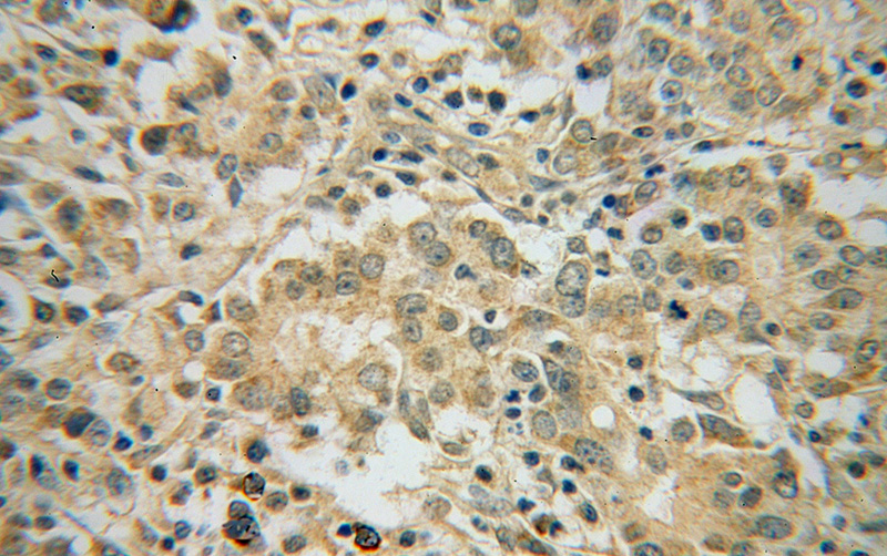 Immunohistochemical of paraffin-embedded human breast cancer using Catalog No:114711(RINT1 antibody) at dilution of 1:50 (under 40x lens)