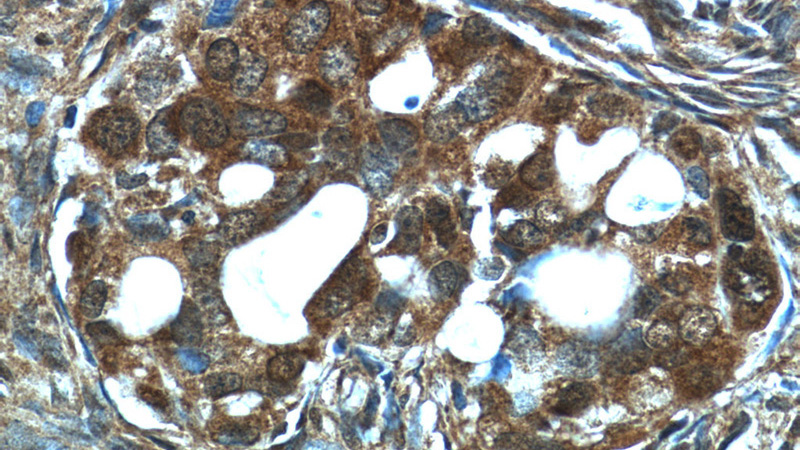 Immunohistochemistry of paraffin-embedded human ovary tumor tissue slide using Catalog No:114390(PSMC3 Antibody) at dilution of 1:50 (under 40x lens)