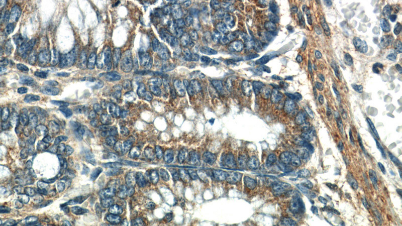 Immunohistochemistry of paraffin-embedded human colon slide using Catalog No:116527(UBE2H Antibody) at dilution of 1:50