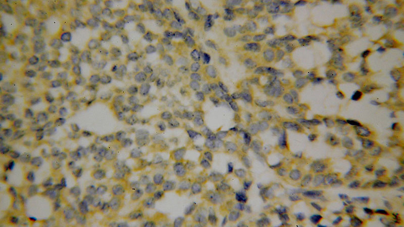 Immunohistochemical of paraffin-embedded human breast cancer using Catalog No:110263(EIF4G1 antibody) at dilution of 1:100 (under 40x lens)