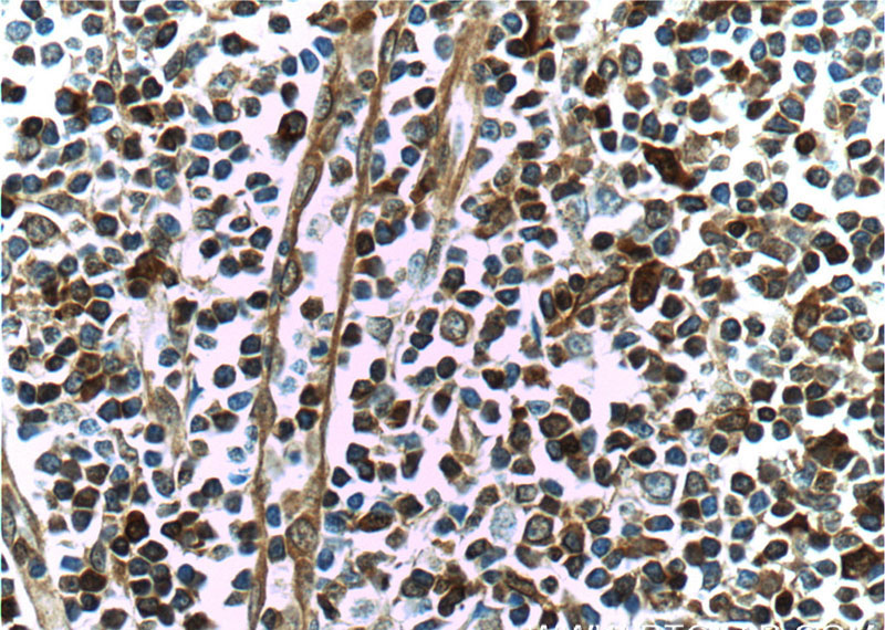 Immunohistochemistry of paraffin-embedded human tonsillitis tissue slide using Catalog No:110892(GBP2 Antibody) at dilution of 1:50 (under 40x lens)