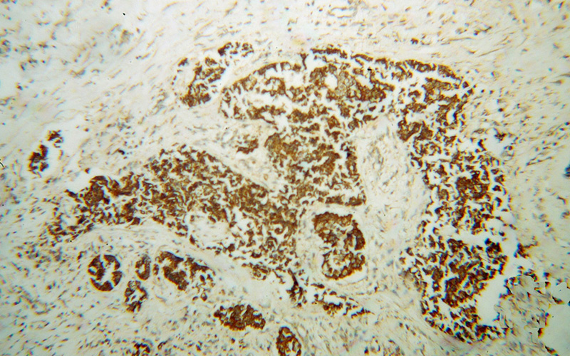 Immunohistochemical of paraffin-embedded human breast cancer using Catalog No:113740(PCK2 antibody) at dilution of 1:100 (under 10x lens)