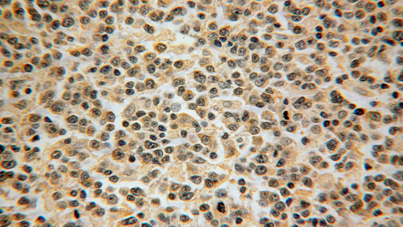 Immunohistochemical of paraffin-embedded human lymphoma using Catalog No:110051(DOK3 antibody) at dilution of 1:50 (under 40x lens)