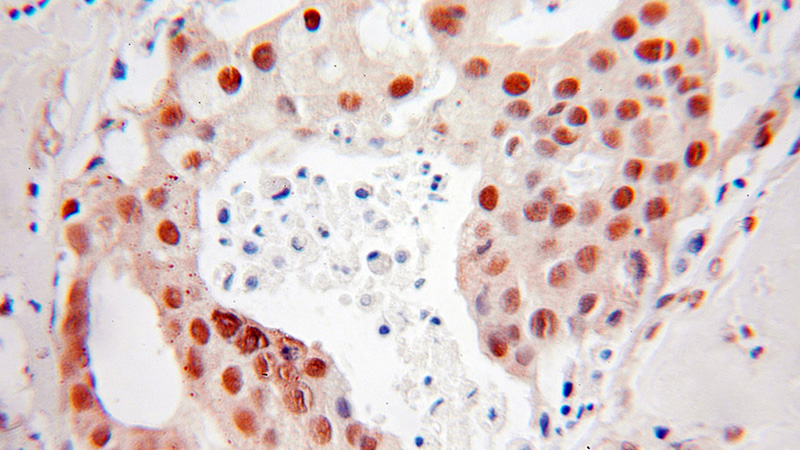 Immunohistochemical of paraffin-embedded human breast cancer using Catalog No:110010(DR1 antibody) at dilution of 1:10 (under 25x lens)