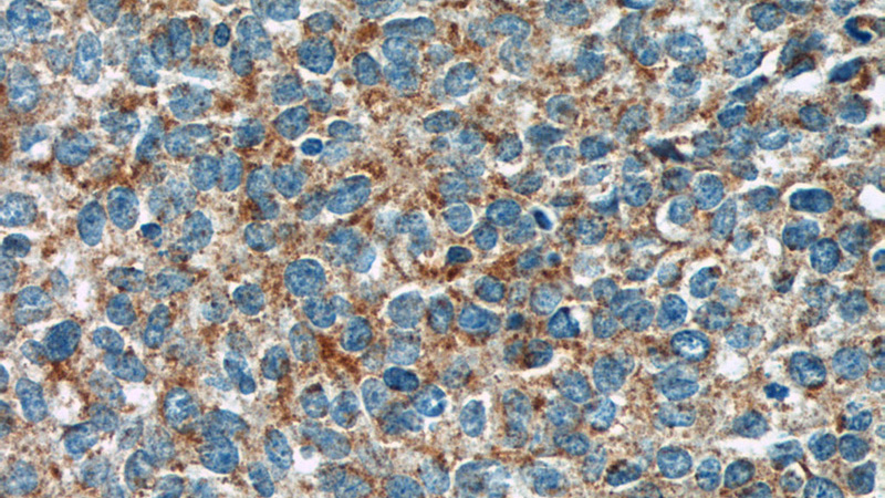 Immunohistochemistry of paraffin-embedded human cervical cancer tissue slide using Catalog No:111017(GKAP1 Antibody) at dilution of 1:50 (under 40x lens)