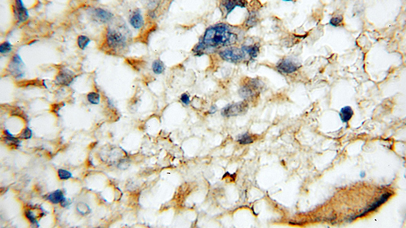 Immunohistochemical of paraffin-embedded human gliomas using Catalog No:115259(SH3GL2 antibody) at dilution of 1:50 (under 10x lens)