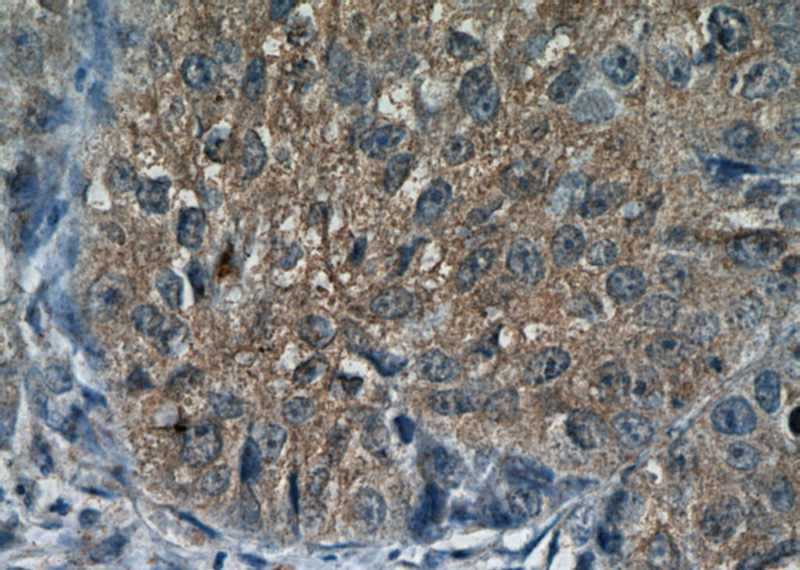 Immunohistochemical of paraffin-embedded human lung cancer using Catalog No:108719(C3orf10 antibody) at dilution of 1:50 (under 40x lens)