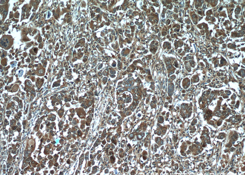 Immunohistochemistry of paraffin-embedded human liver cancer tissue slide using Catalog No:111484(HMGCR Antibody) at dilution of 1:50 (under 10x lens)