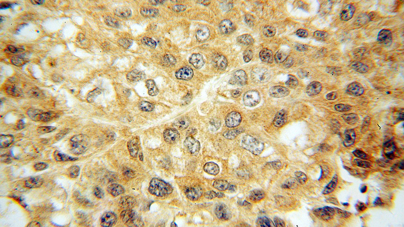 Immunohistochemical of paraffin-embedded human lung cancer using Catalog No:112032(KEAP1 antibody) at dilution of 1:100 (under 40x lens)