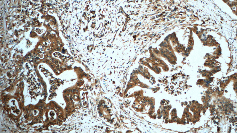 Immunohistochemistry of paraffin-embedded human pancreas cancer tissue slide using Catalog No:116692(USP9X Antibody) at dilution of 1:50 (under 10x lens)