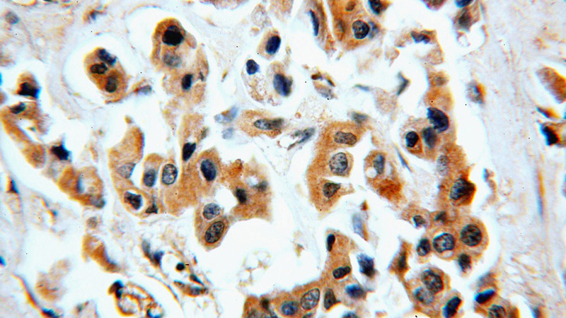 Immunohistochemical of paraffin-embedded human breast cancer using Catalog No:109298(CHST3 antibody) at dilution of 1:50 (under 40x lens)