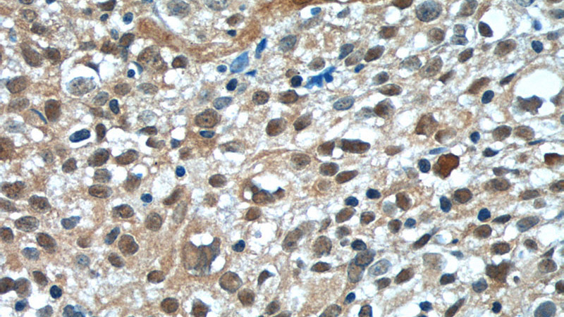Immunohistochemistry of paraffin-embedded human lung cancer tissue slide using Catalog No:113289(NSFL1C Antibody) at dilution of 1:50 (under 40x lens)