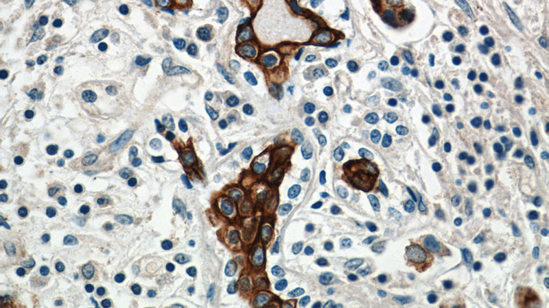 Immunohistochemistry of paraffin-embedded human breast cancer tissue slide using Catalog No:109342(Claudin 4-specific Antibody) at dilution of 1:50 (under 40x lens)