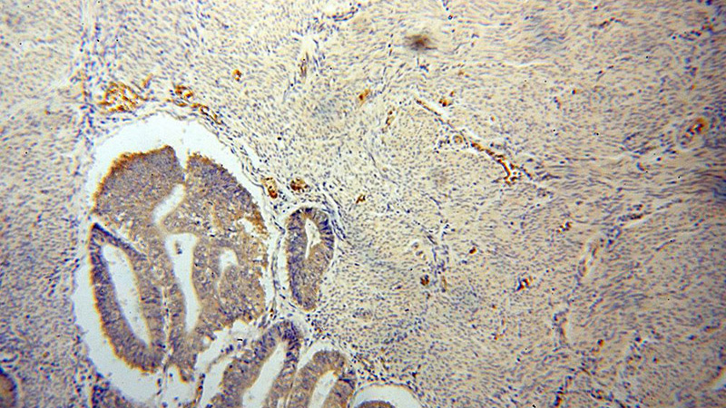 Immunohistochemical of paraffin-embedded human endometrial cancer using Catalog No:114838(RPS27 antibody) at dilution of 1:50 (under 10x lens)