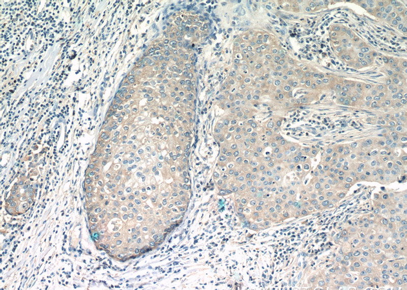 Immunohistochemistry of paraffin-embedded human breast cancer tissue slide using Catalog No:114407(RAB11FIP1 Antibody) at dilution of 1:50 (under 10x lens)