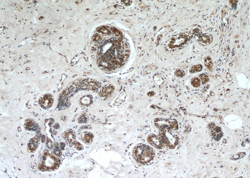 Immunohistochemical of paraffin-embedded human breast cancer using Catalog No:110776(FRK antibody) at dilution of 1:50 (under 10x lens)