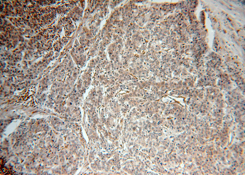 Immunohistochemical of paraffin-embedded human liver cancer using Catalog No:110348(EPHA1-special antibody) at dilution of 1:100 (under 10x lens)