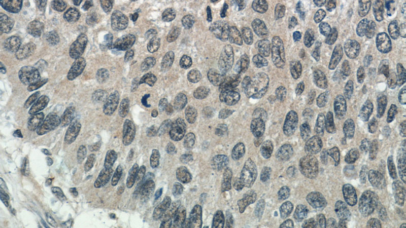 Immunohistochemistry of paraffin-embedded human cervical cancer tissue slide using Catalog No:113180(NHP2L1 Antibody) at dilution of 1:50 (under 40x lens)