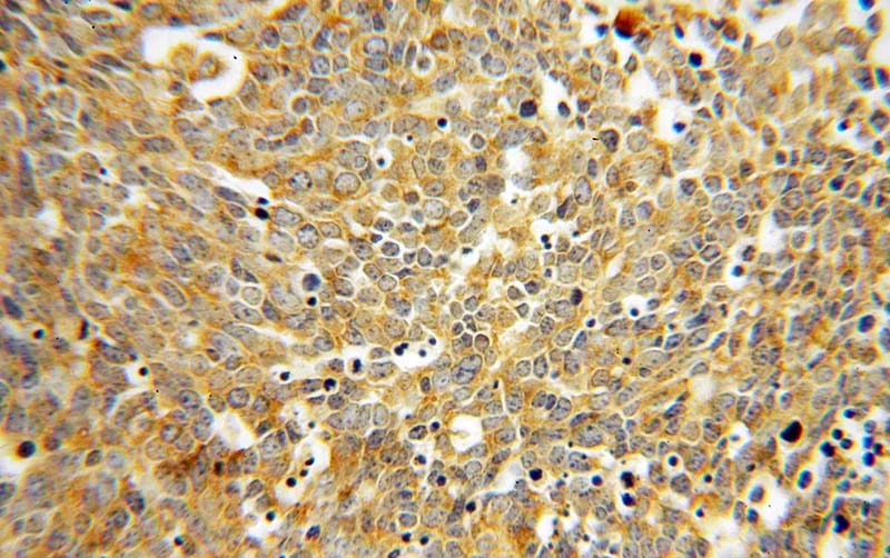 Immunohistochemical of paraffin-embedded human lung cancer using Catalog No:108310(ATP6V1D antibody) at dilution of 1:100 (under 40x lens)