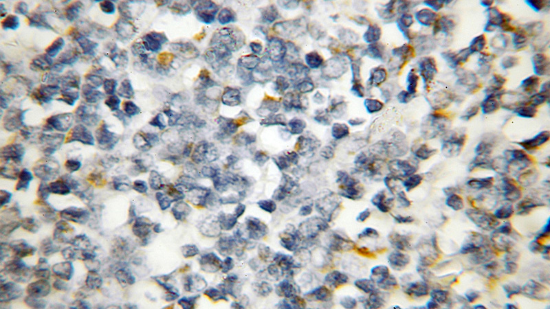 Immunohistochemical of paraffin-embedded human lymphoma using Catalog No:108127(AP4M1 antibody) at dilution of 1:50 (under 10x lens)