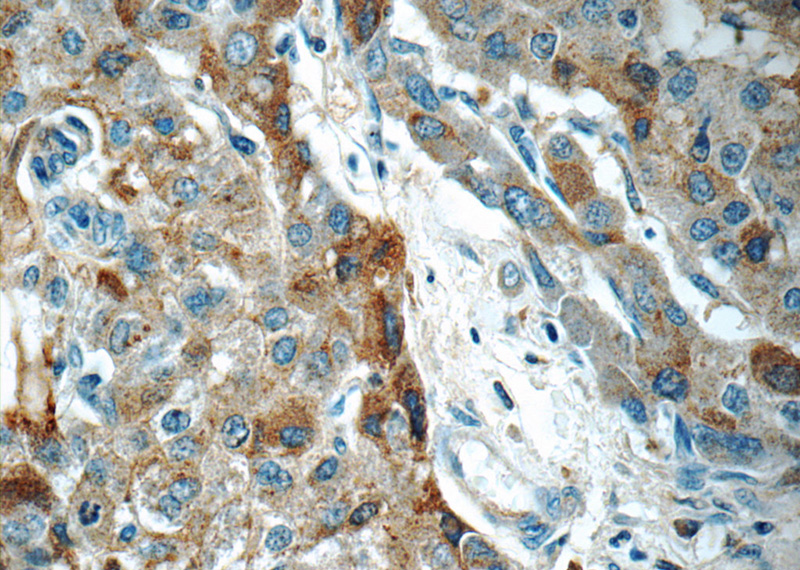 Immunohistochemistry of paraffin-embedded human liver cancer tissue slide using Catalog No:107372(LBP Antibody) at dilution of 1:50 (under 40x lens)