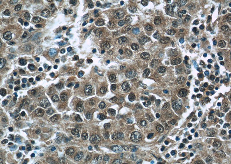 Immunohistochemistry of paraffin-embedded human liver cancer tissue slide using Catalog No:111371(HDAC10 Antibody) at dilution of 1:50 (under 40x lens)