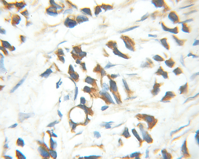 Immunohistochemical of paraffin-embedded human prostate cancer using Catalog No:112584(MED15 antibody) at dilution of 1:100 (under 10x lens)