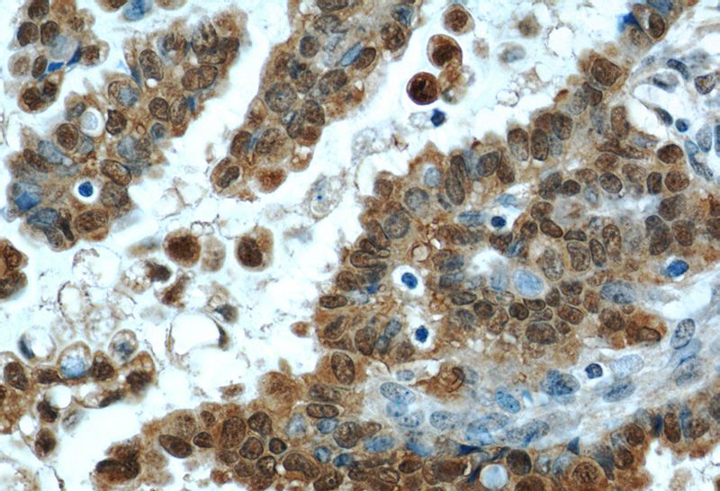 Immunohistochemical of paraffin-embedded human ovary tumor using Catalog No:108091(ANXA11 antibody) at dilution of 1:50 (under 40x lens)