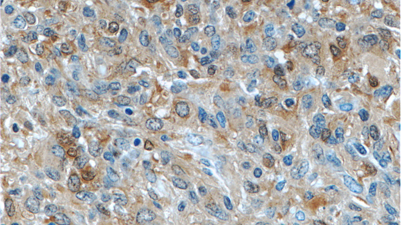 Immunohistochemistry of paraffin-embedded human gliomas tissue slide using Catalog No:111602(IDH1 Antibody) at dilution of 1:50 (under 40x lens)