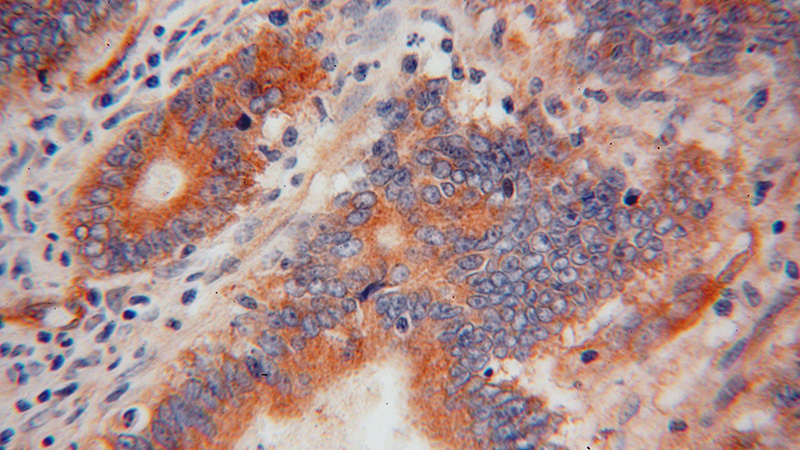 Immunohistochemical of paraffin-embedded human colon cancer using Catalog No:114564(RBP7 antibody) at dilution of 1:50 (under 40x lens)