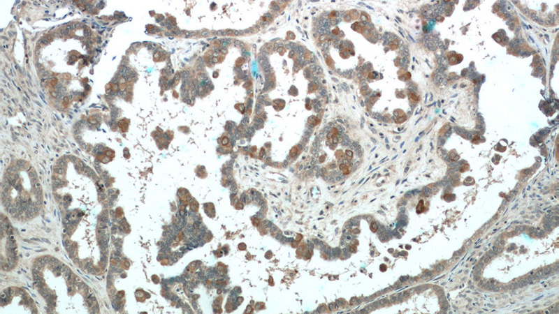 Immunohistochemistry of paraffin-embedded human ovary tumor tissue slide using Catalog No:113665(PDE6A Antibody) at dilution of 1:50 (under 10x lens)