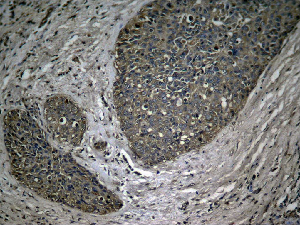 Immunohistochemical analysis of paraffin-embedded human breast carcinoma tissue using NF-κB p65 (Phospho-Ser536) Antibody .