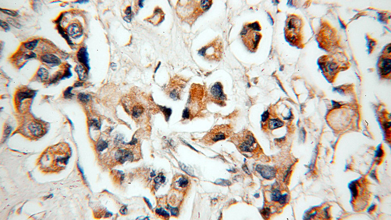 Immunohistochemical of paraffin-embedded human breast cancer using Catalog No:111684(IGFBP2 antibody) at dilution of 1:50 (under 40x lens)