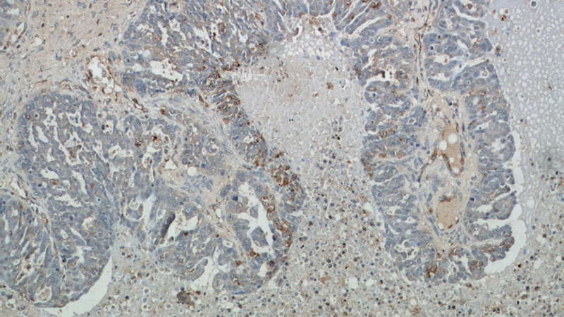 Immunohistochemical of paraffin-embedded human ovary tumor using Catalog No:112807(ABCC5 antibody) at dilution of 1:50 (under 10x lens)