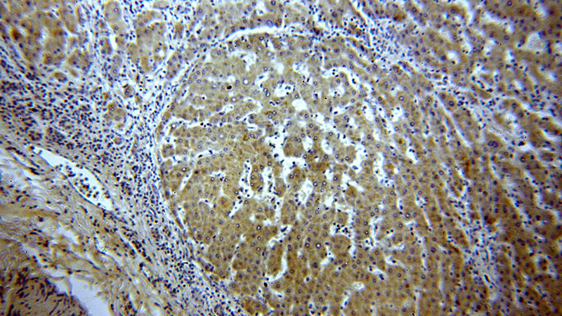Immunohistochemical of paraffin-embedded human hepatocirrhosis using Catalog No:111493(HMP19 antibody) at dilution of 1:50 (under 10x lens)