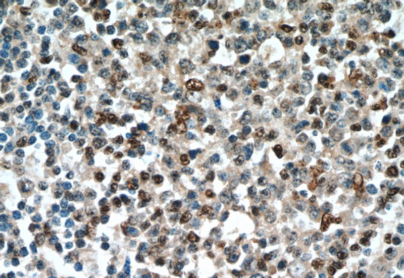 Immunohistochemical of paraffin-embedded human tonsillitis using Catalog No:115841(SUPT16H antibody) at dilution of 1:100 (under 40x lens)
