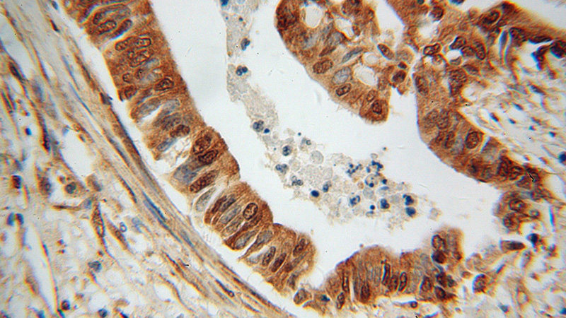 Immunohistochemical of paraffin-embedded human pancreas cancer using Catalog No:114907(RPS3A antibody) at dilution of 1:100 (under 40x lens)
