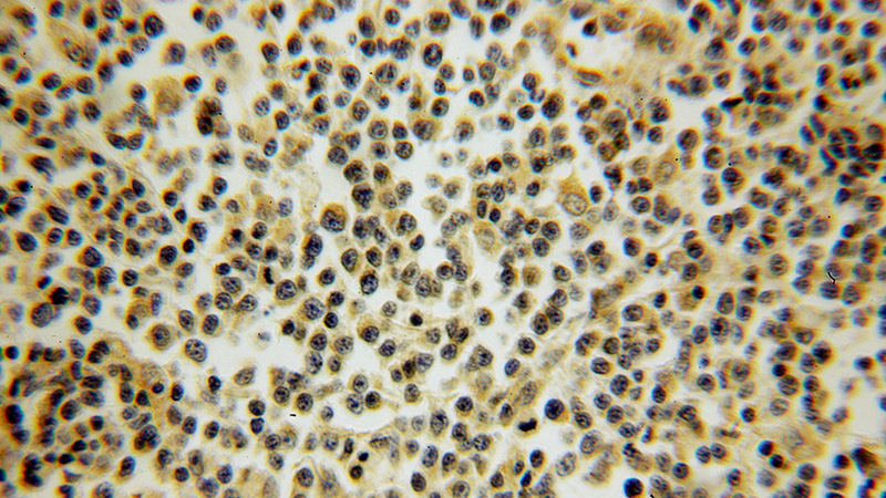 Immunohistochemical of paraffin-embedded human lymphoma using Catalog No:115791(STX11 antibody) at dilution of 1:100 (under 10x lens)