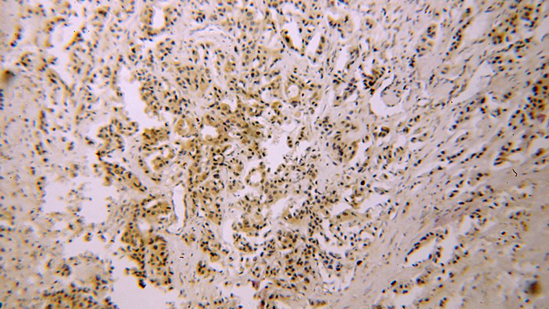 Immunohistochemical of paraffin-embedded human breast cancer using Catalog No:115750(SURVIVIN-Specific antibody) at dilution of 1:50 (under 10x lens)