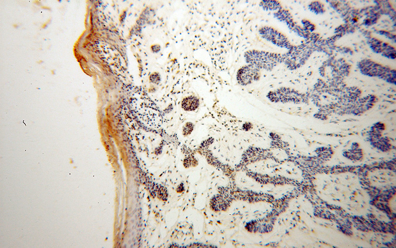 Immunohistochemical of paraffin-embedded human skin cancer using Catalog No:112141(TMPO antibody) at dilution of 1:100 (under 10x lens)