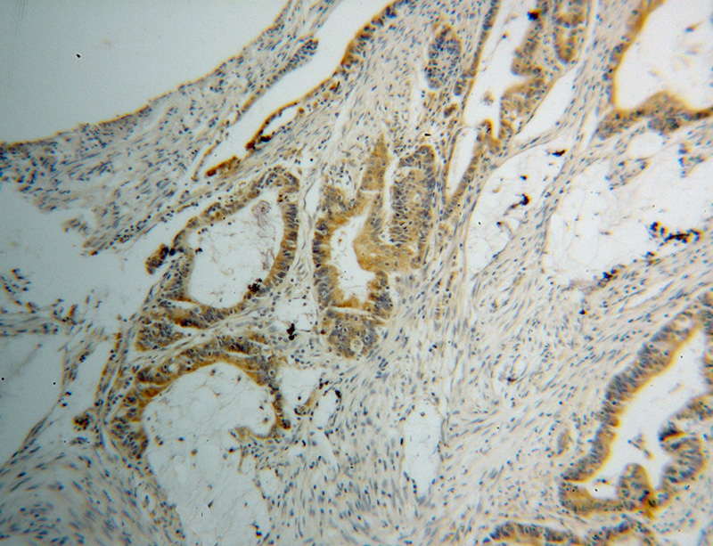 Immunohistochemical of paraffin-embedded human colon cancer using Catalog No:116714(VAPA antibody) at dilution of 1:100 (under 10x lens)