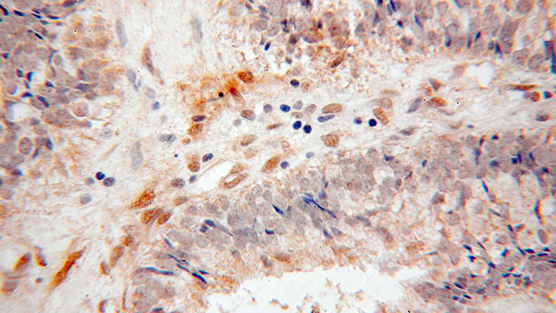 Immunohistochemical of paraffin-embedded human ovary tumor using Catalog No:114567(RBPMS antibody) at dilution of 1:50 (under 40x lens)