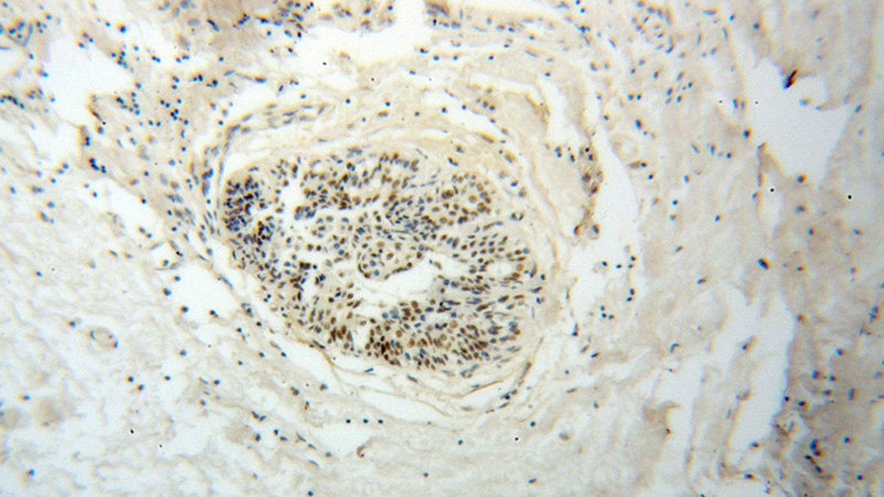 Immunohistochemical of paraffin-embedded human breast cancer using Catalog No:114800(POLR2E antibody) at dilution of 1:100 (under 10x lens)
