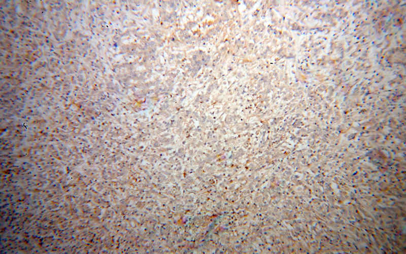 Immunohistochemical of paraffin-embedded human breast cancer using Catalog No:115686(STAT2 antibody) at dilution of 1:50 (under 10x lens)